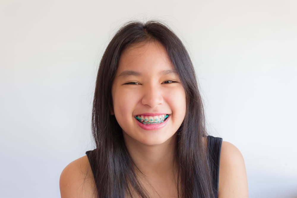 Braces in Los Angeles, CA - LA Dental Clinic