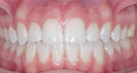 teeth front view teeth front view