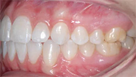 teeth left view teeth left view