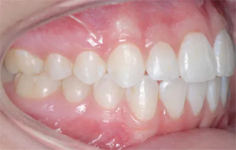 teeth right view teeth right view