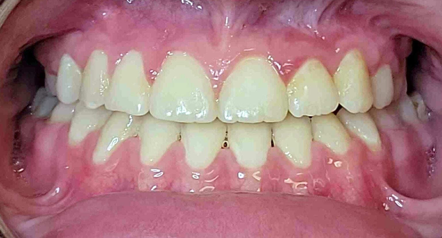 Underbite: Before and After Treatment at BHO