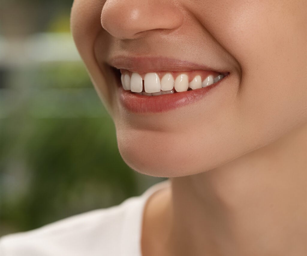 Overbite: Before and After Treatment at BHO