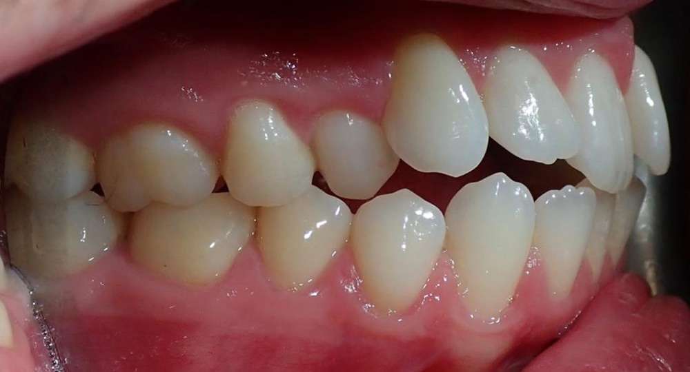 Crossbite-Before-Patient-teeth-1