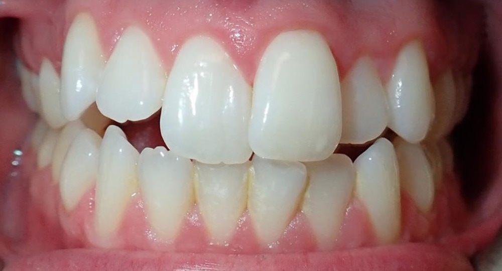 Crossbite-Before-Patient-teeth-3
