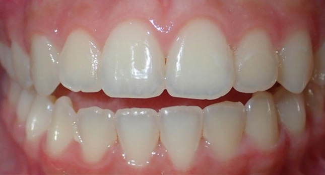 Openbite-Before-Patient-1-teeth-3