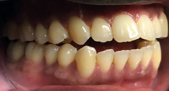 Openbite-Before-Patient-teeth-1