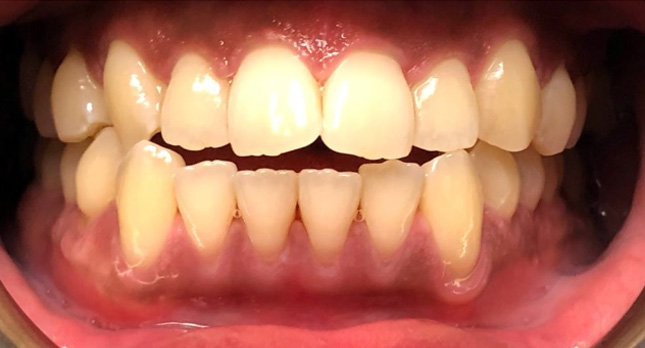 Openbite-Before-Patient-teeth-3