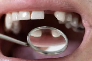 Missing lateral Incisor