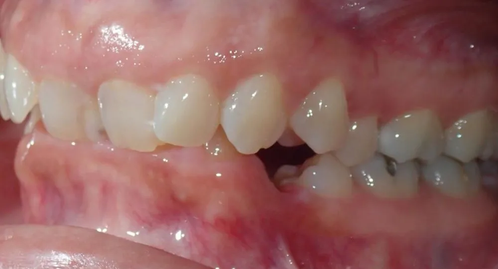 Deep Bite Correction: Before & After Photos & Results