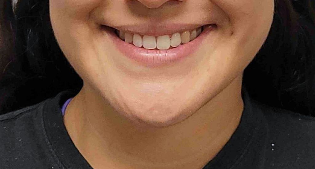 after photo of 2nd patient who had crooked teeth