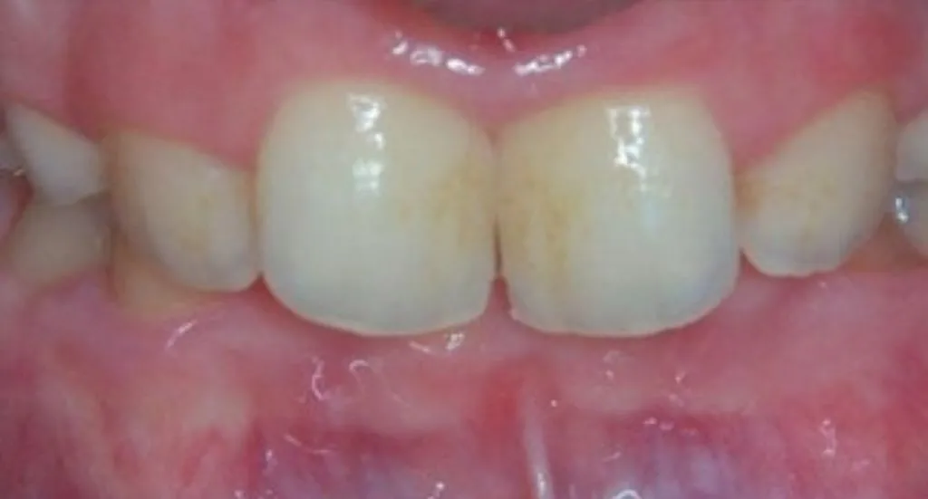Transform Your Smile: Overbite Treatment Results at BHO