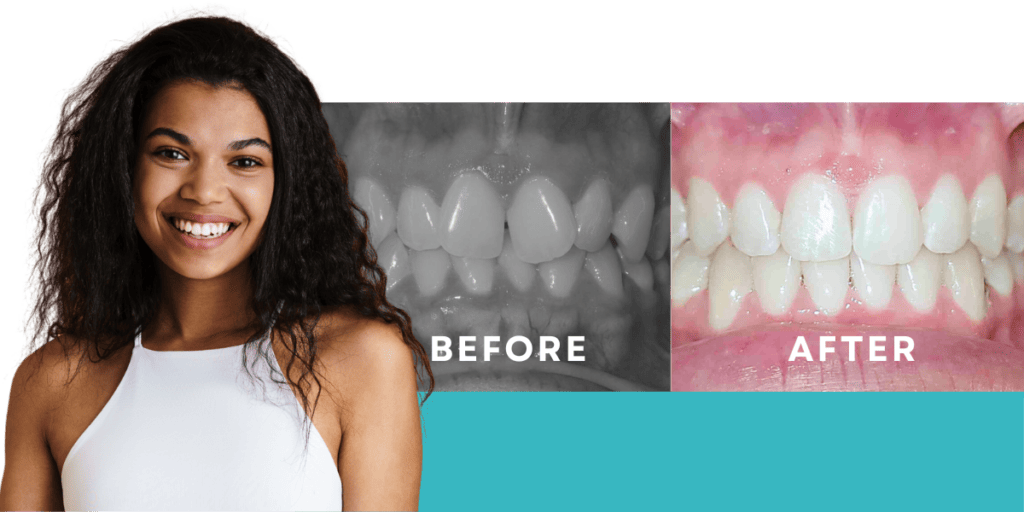Crooked Teeth Before & After
