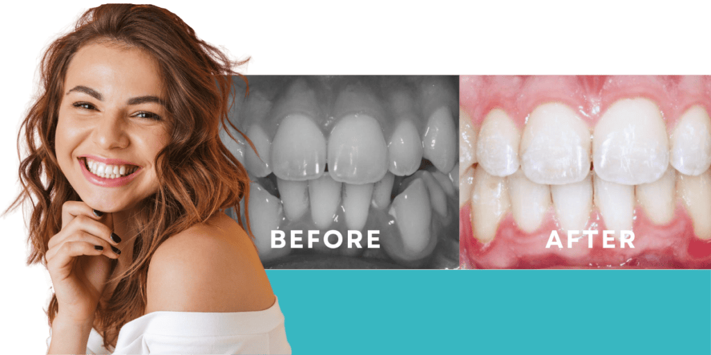 Crowded Teeth Before & After
