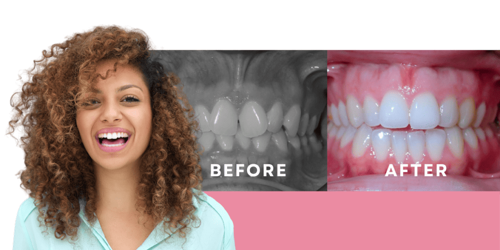 Invisalign before & after