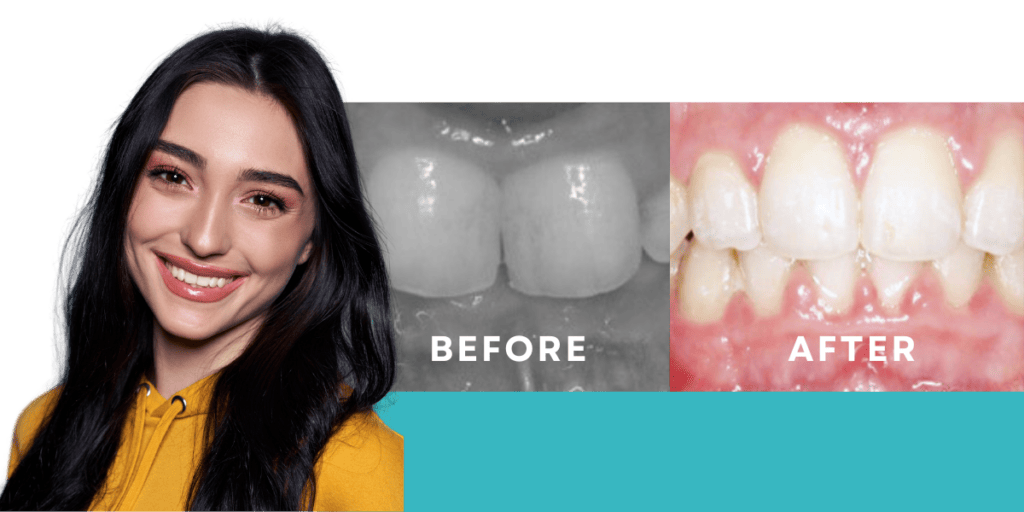 Overbite Before & After