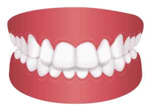 3d image of an overbite