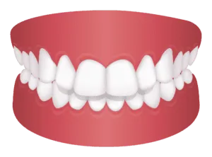3d image of an overbite