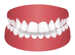 3d image of an overjet