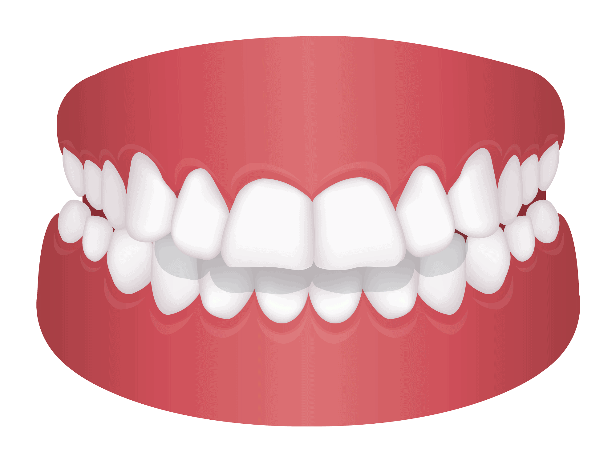 Overjet Vs Overbite - The Difference And How To Correct - Beverly Hills ...