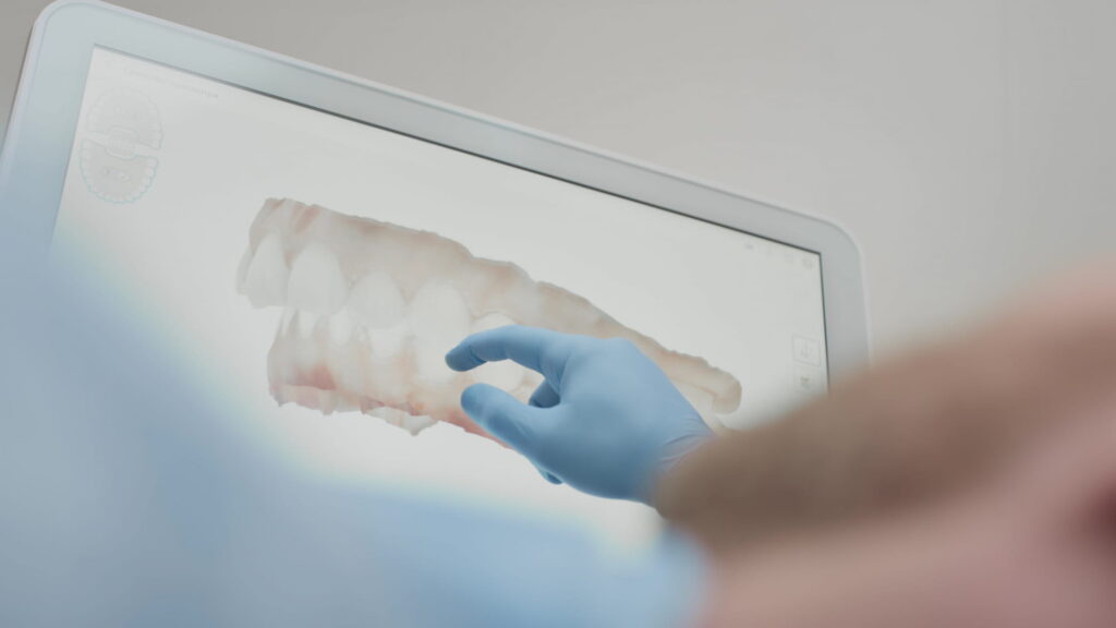 itero intraoral scanner